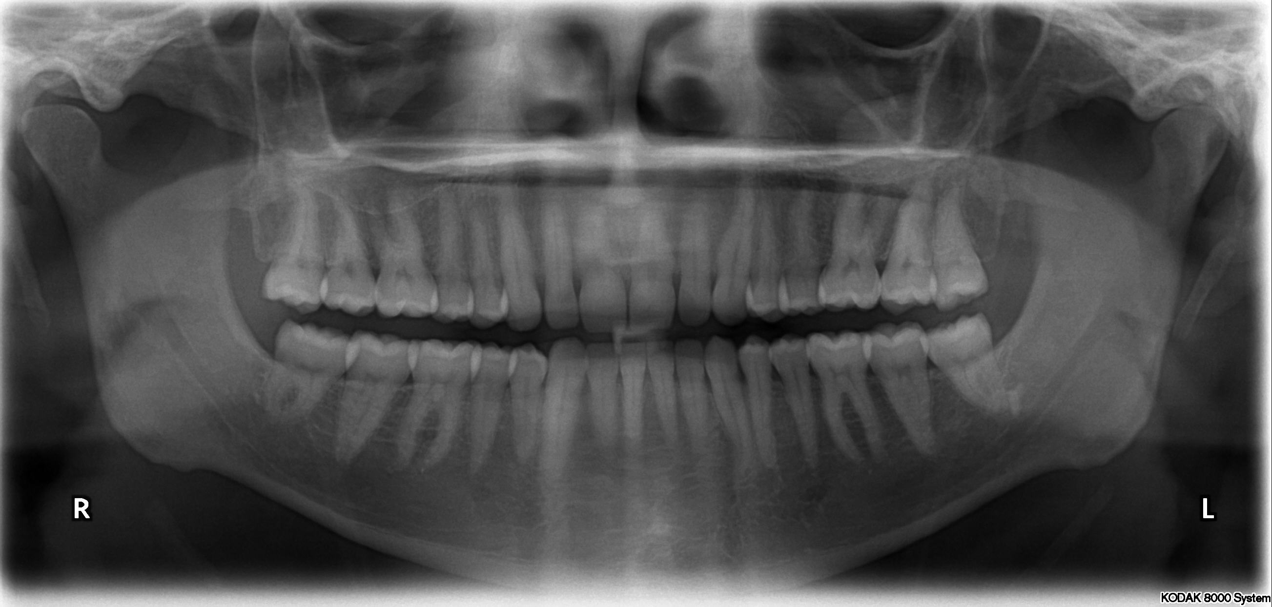 Real panoramic dental radiograph showing upper and lower teeth